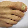 UV LED On Toenail Fugus |  I have invented a new word: FugusSomehow the 'n' went missing for my...