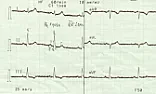 F: EKG Schaltungstechnik  |  "Johannes Schöller"konventionellen EKG gibt es ja zum einen die 3 Ableitungen...